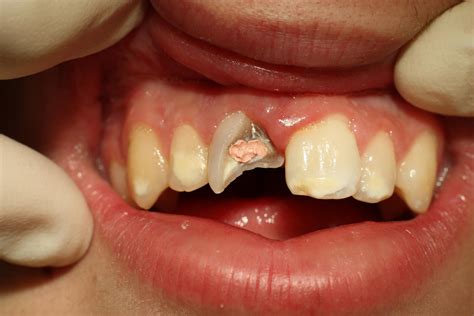 The Cost of Magic Porcelain Chipped Tooth Repair: A Comprehensive Guide